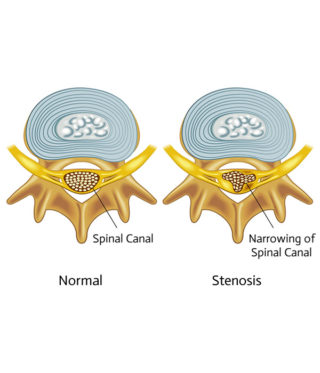 Spinal Stenosis - Charlotte Chiropractic Center, PLLC